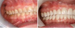dentist-coquitlam-before-after-pic-group3-pic4